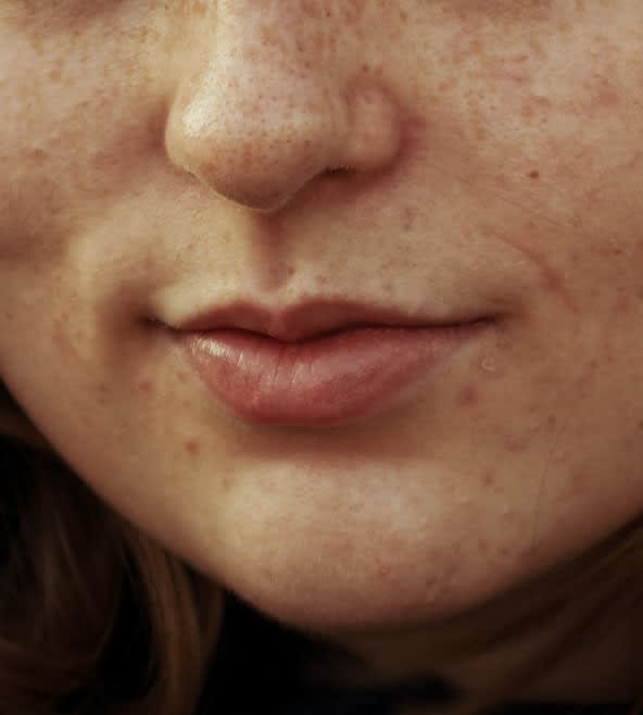 Acne Scar Solutions Overview - 1102