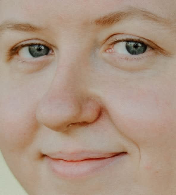 Rosacea Solutions Overview - 1144