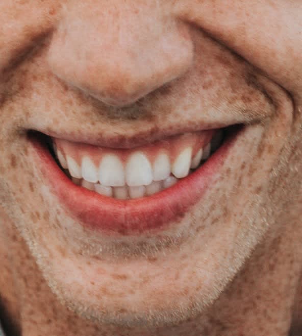 Teeth Whitening Overview - 1005