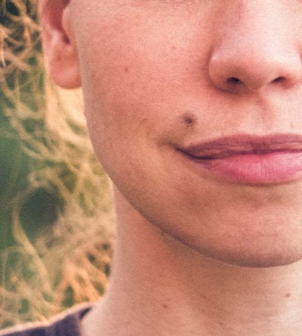 Awake Lip Lift Overview - 1156