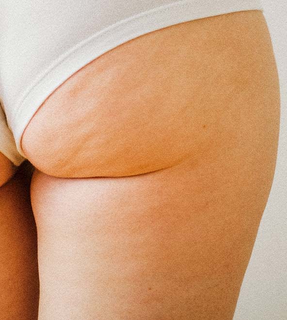 VelaSmooth™ Overview - 1034