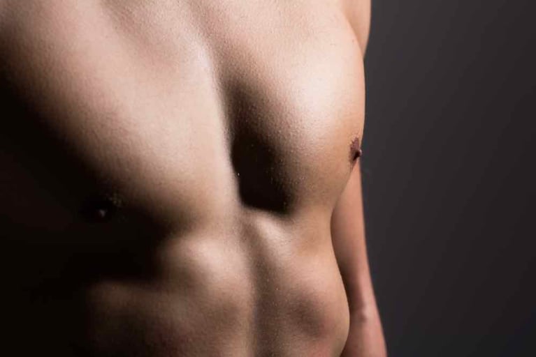 Everything You Need To Know About Gynecomastia