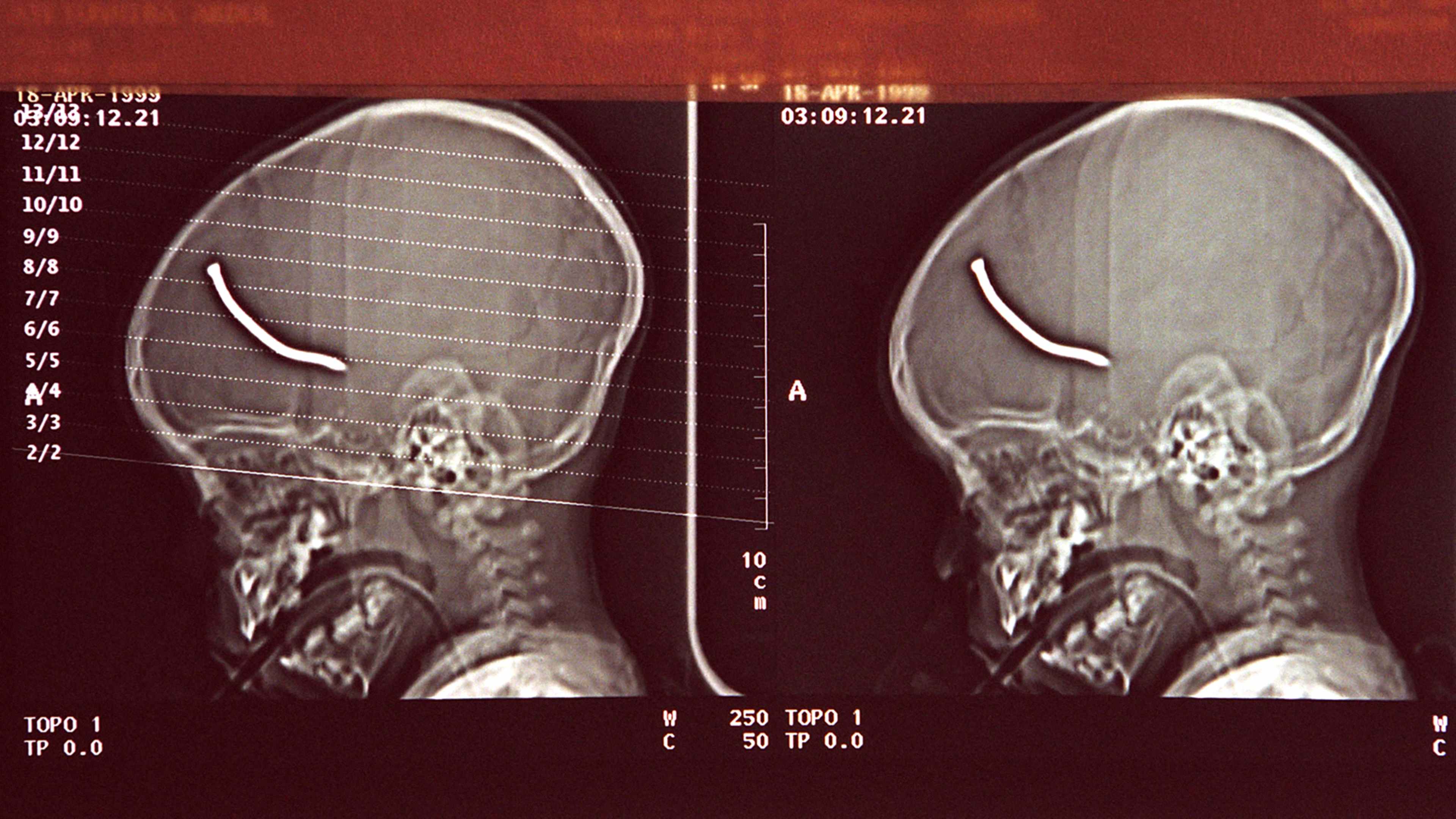 The image shows an X-ray of a person's feet, with the bones and joints clearly visible. The background includes numerical information and labels related to the X-ray.