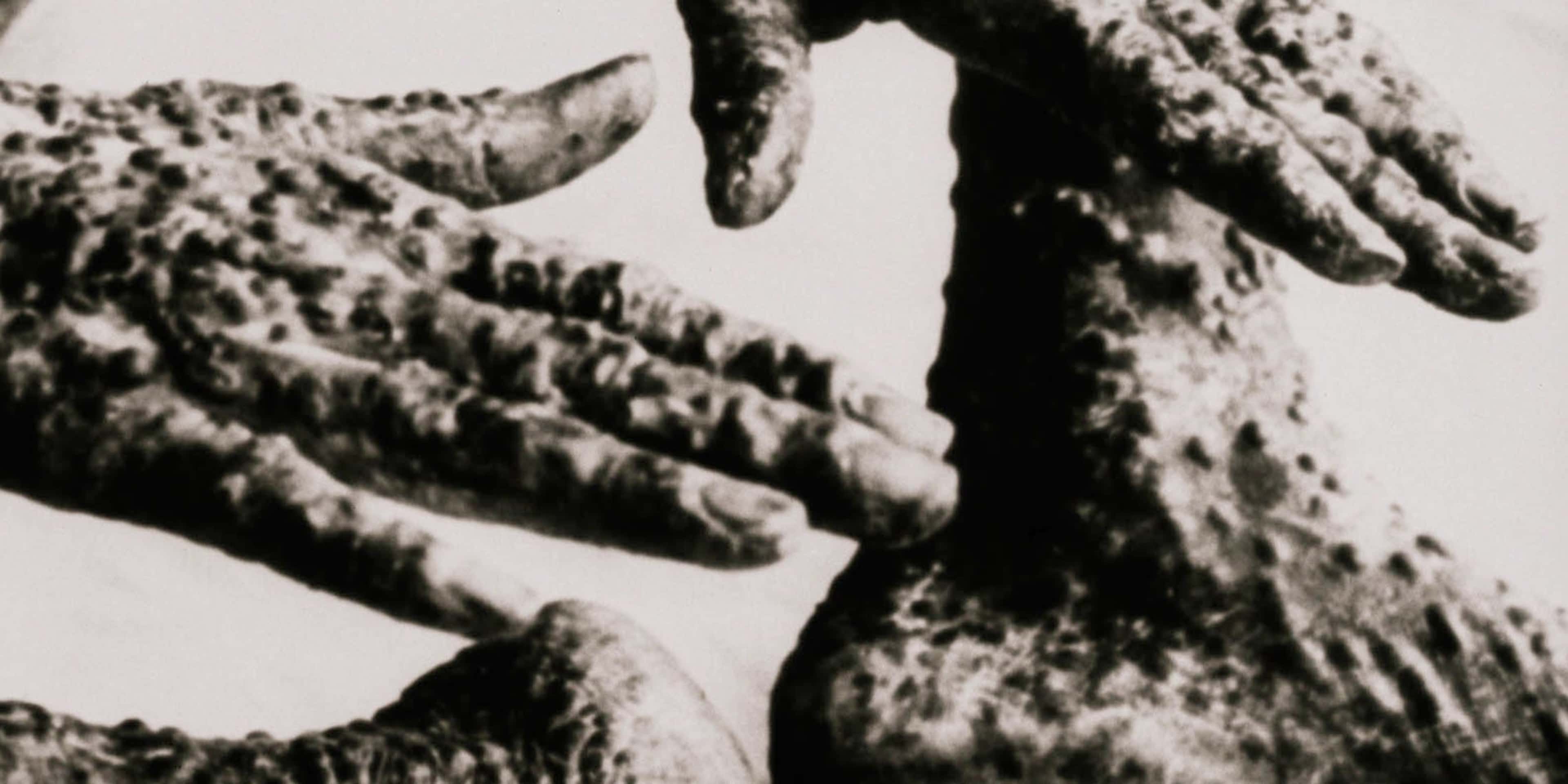 Smallpox