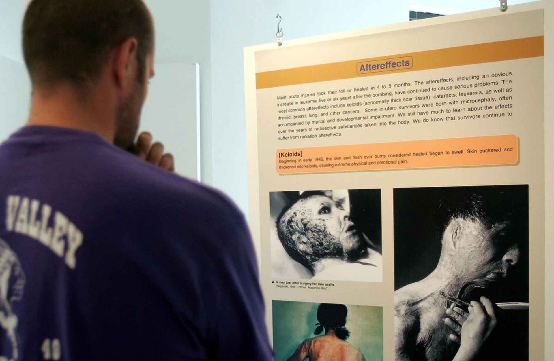 An informational panel describing the aftereffects of the A-Bomb at an exhibit titled "60 Years Later: The Hiroshima-Nagasaki A-Bomb Exhibition" at Chicago's Peace Museum, in collaboration with the Nagasaki Peace Memorial Hall and the Hiroshima Peace Memorial Museum, in 2005. (Credit: Tim Boyle/Getty Images)