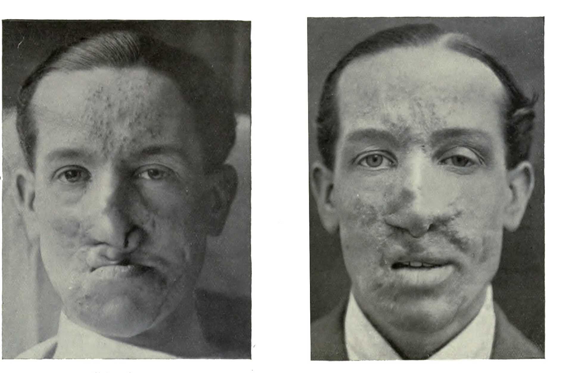 WWI Plastic Surgery