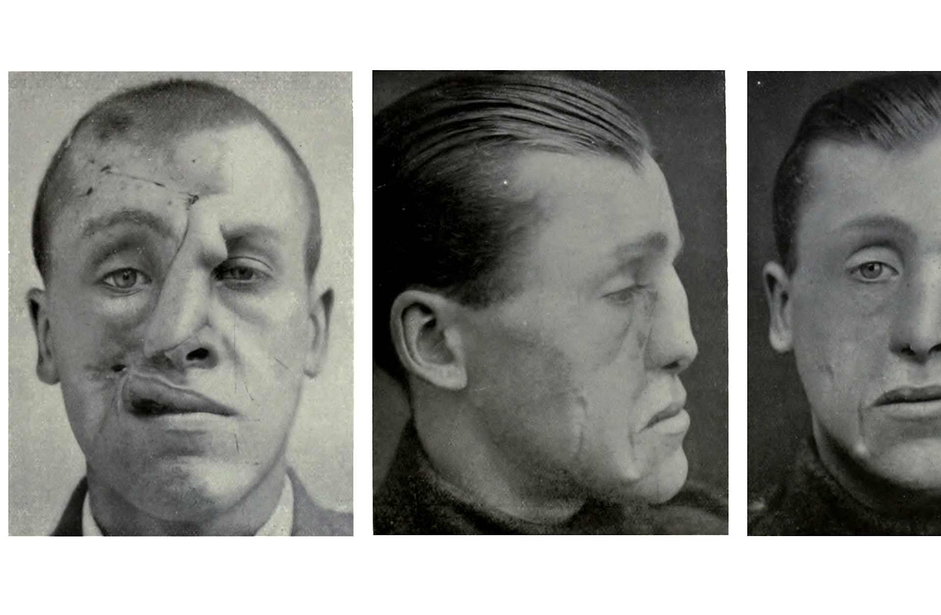 WWI Plastic Surgery