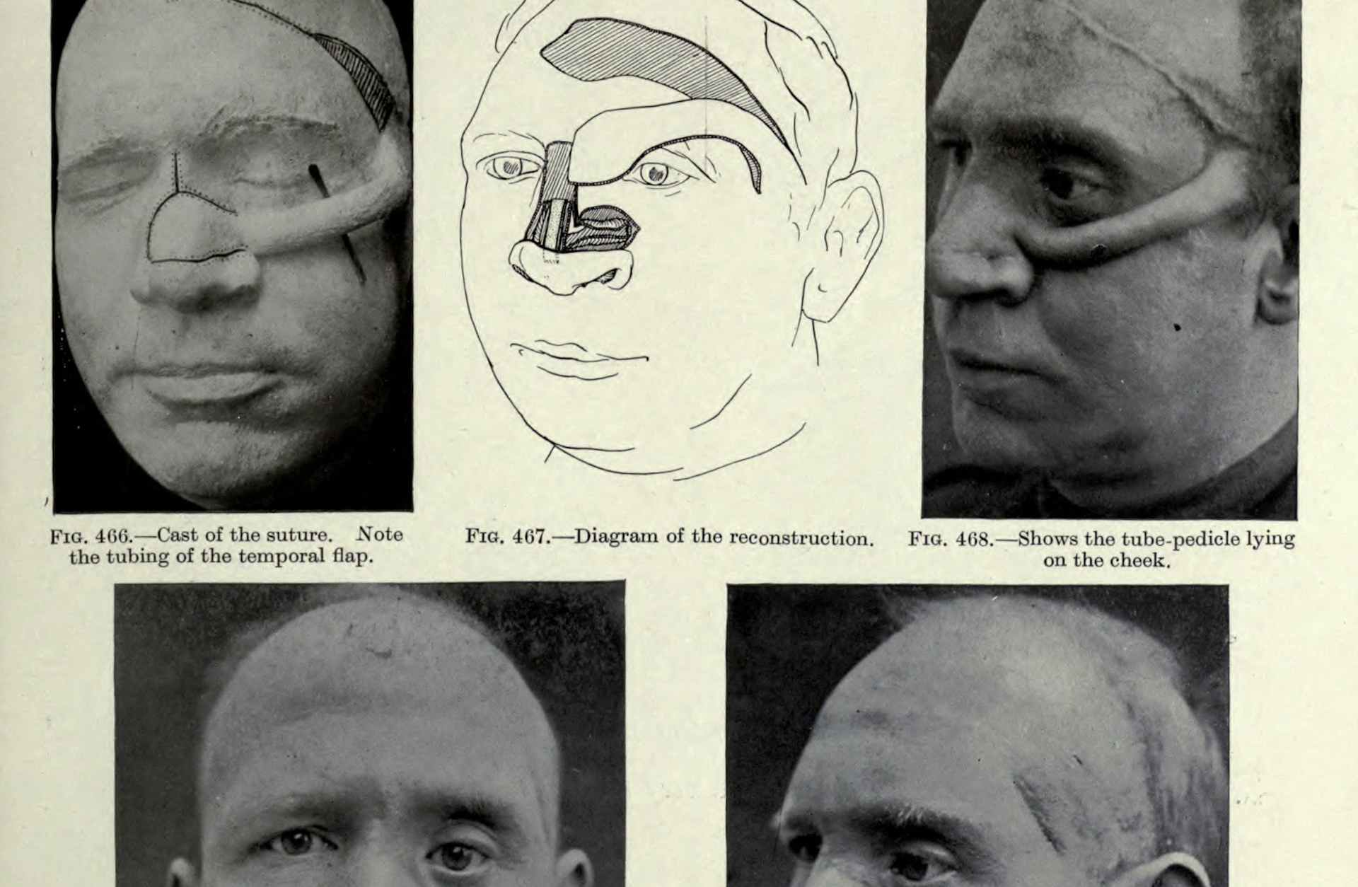 plastic surgery of World War I