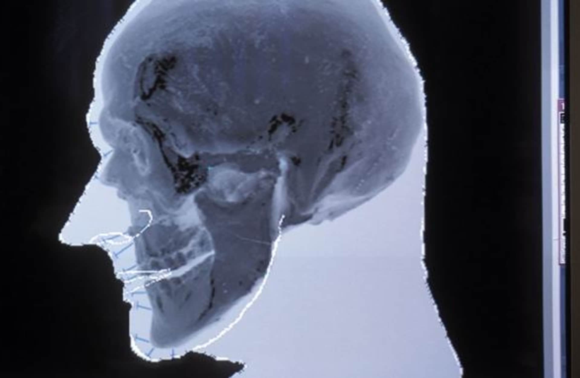 The probable shape of Otzi's face is produced and superimposed over the digital image of his actual skull as part of the facial reconstruction. (Photo by Patrick Landmann/Getty Images)