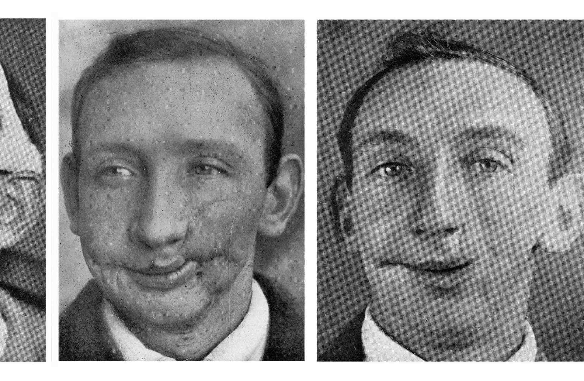 WWI Plastic Surgery