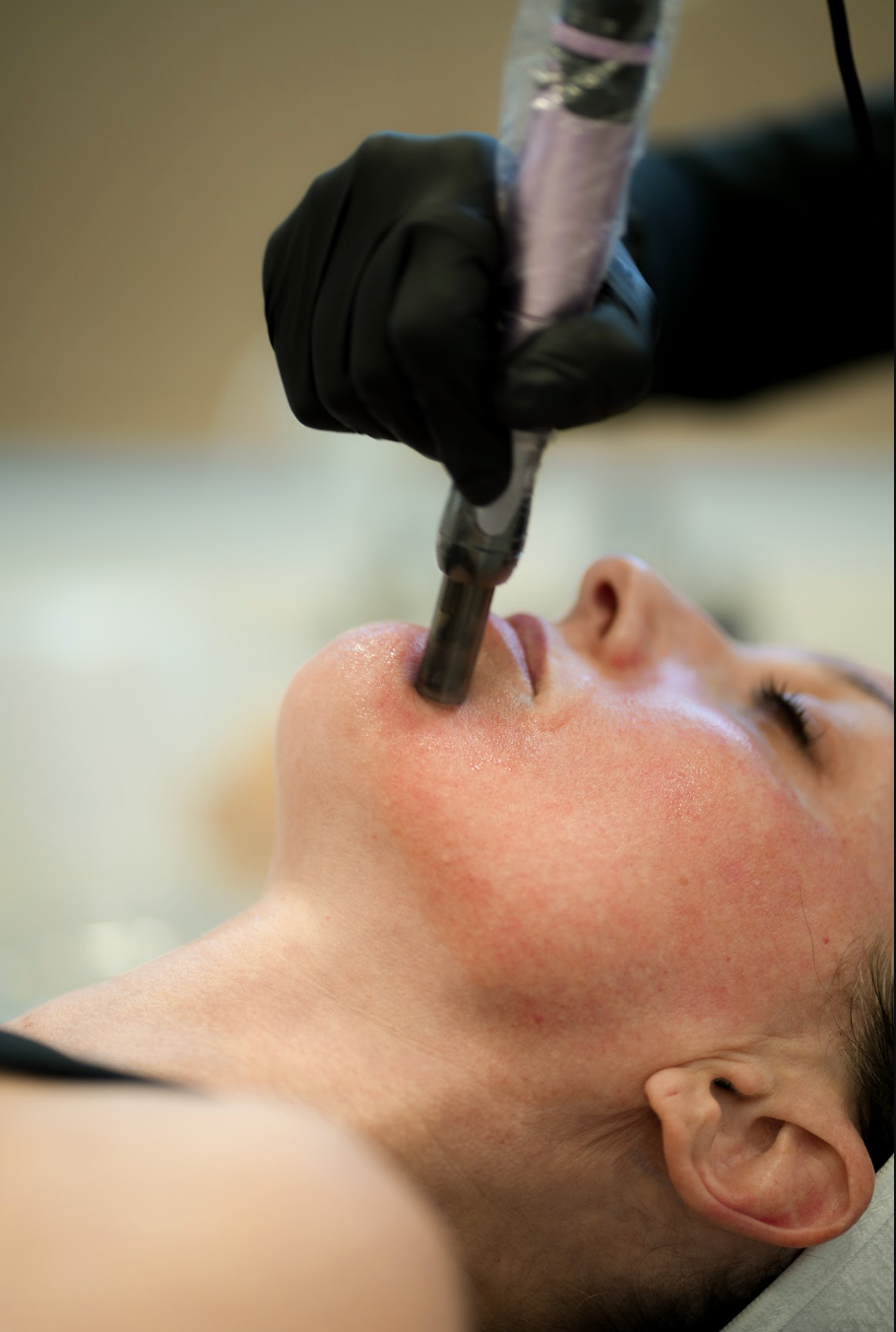 Microneedling in West Des Moines
