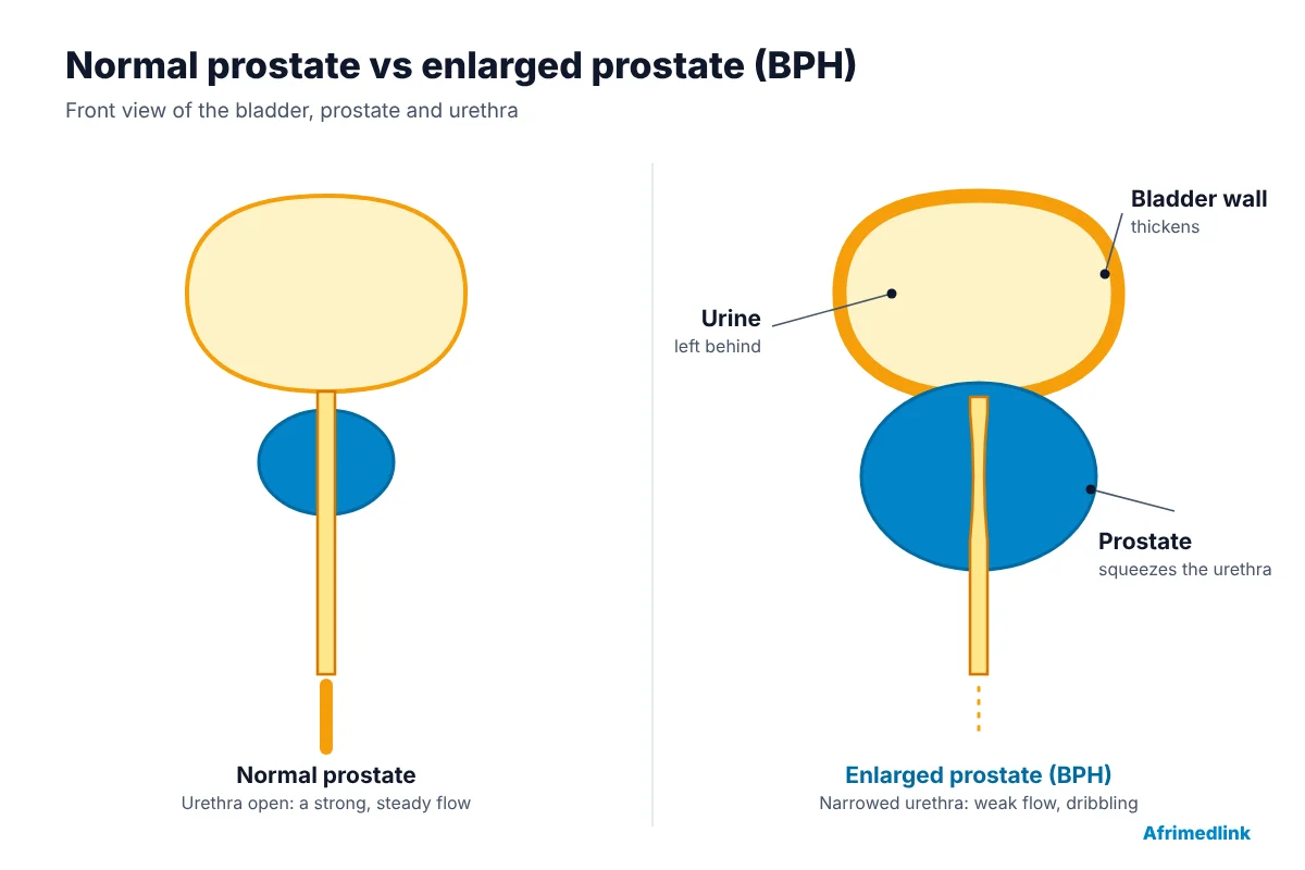 In BPH the enlarged prostate narrows the urethra. The bladder has to work harder, its wall thickens, and urine is often left behind.