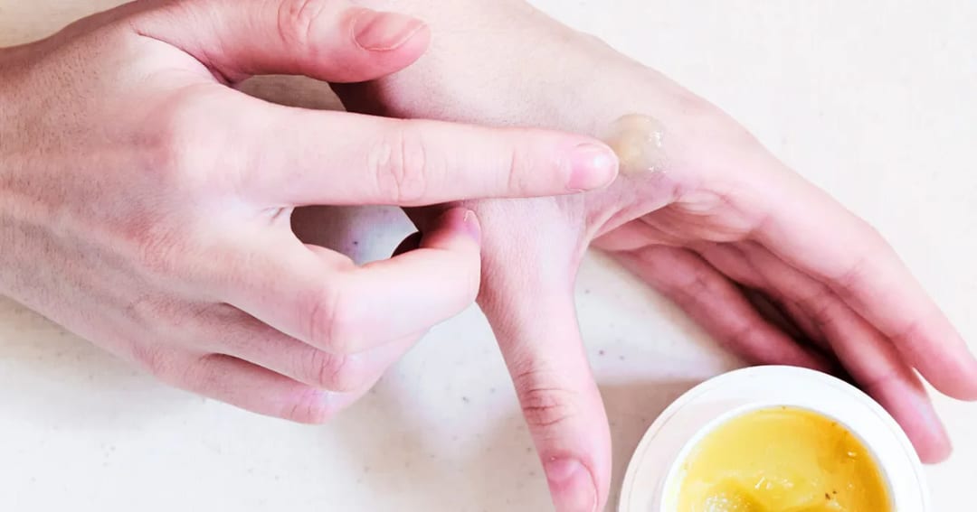 Everyone's Favorite Natural Scar Butter