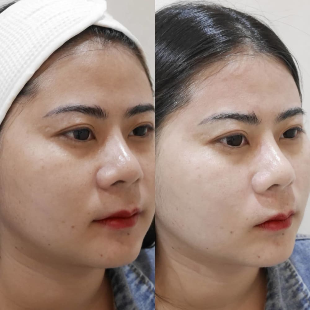 Warm Sand & 9 Micro Needle on July 31, 2019 Warm Sand & 9 Micro Needle on July 31, 2019