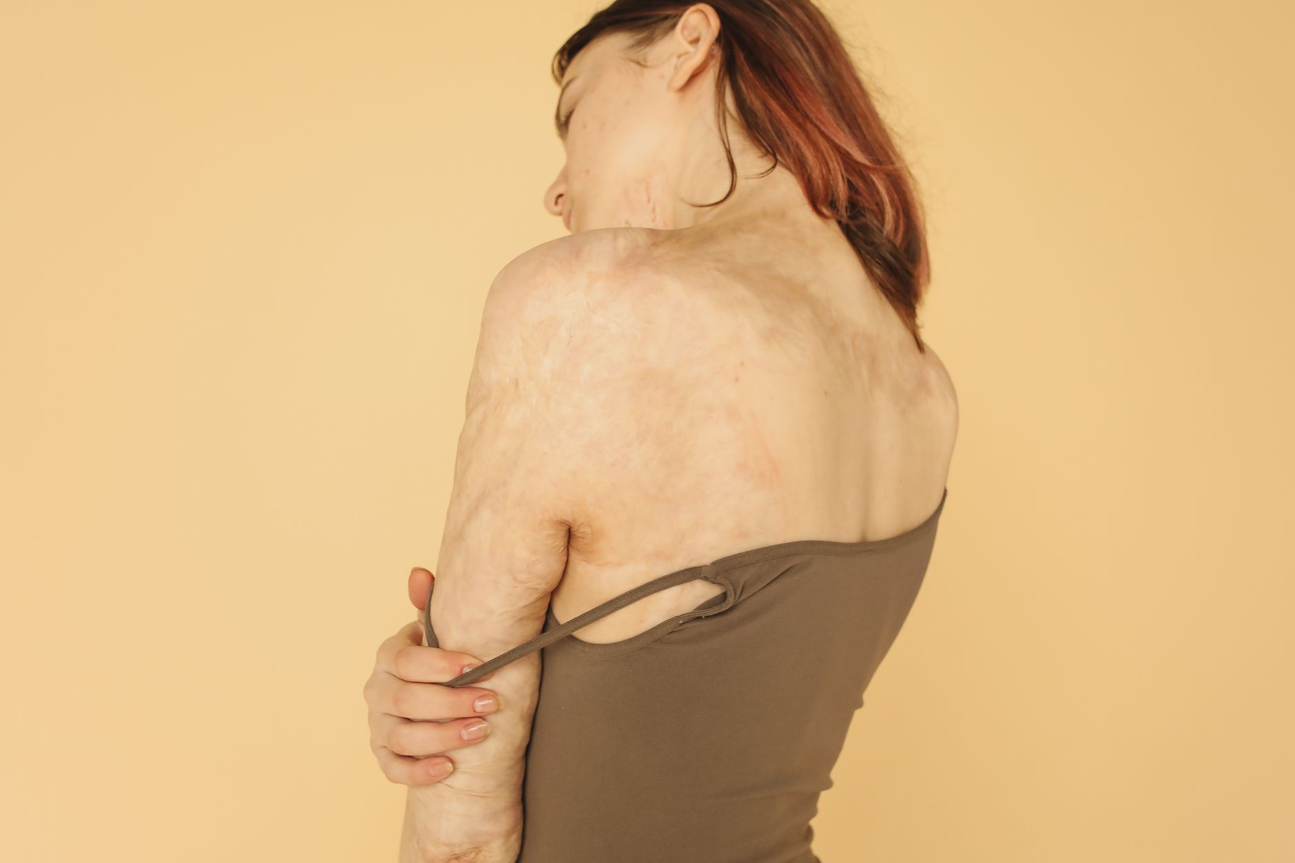 5 Reasons Why Scar Revision Is Worth A Deal