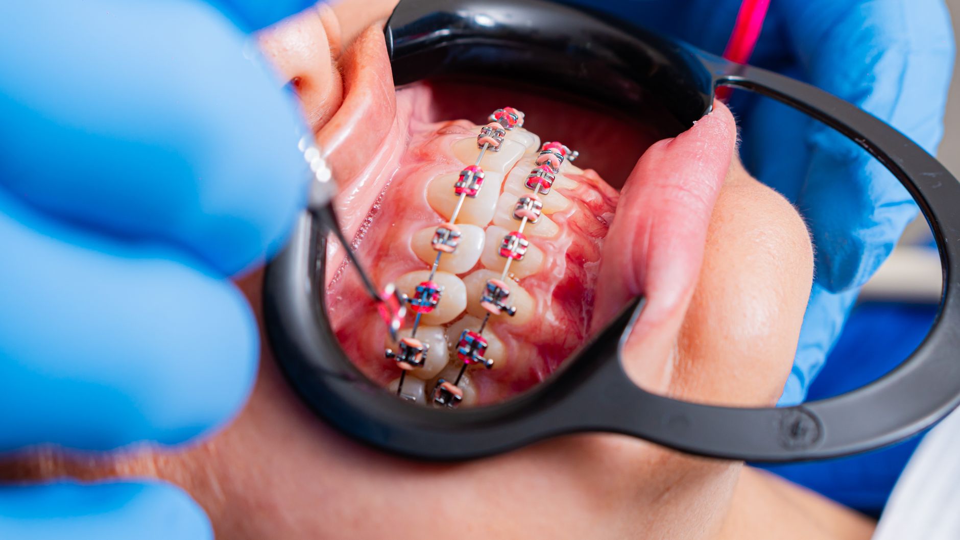 Invisible Braces – A Modern Appliance to Correct the Teeth Alignment