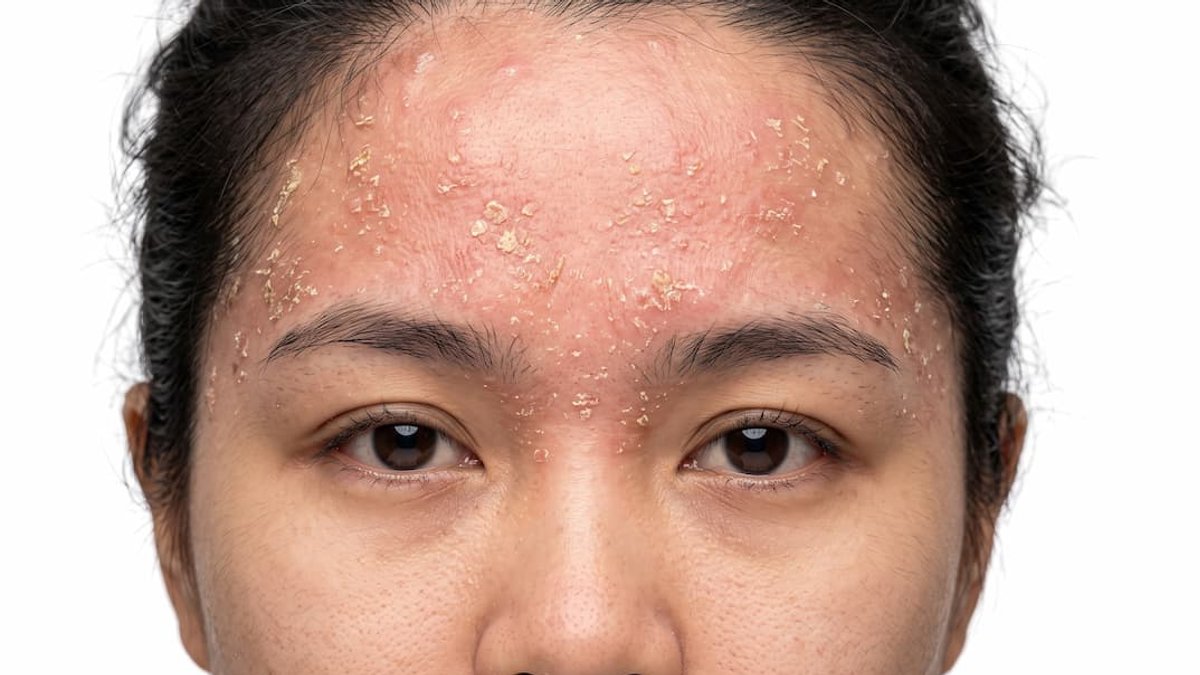 Anti-inflammatories emerge as new seborrheic dermatitis treatment - seborrheic dermatitis