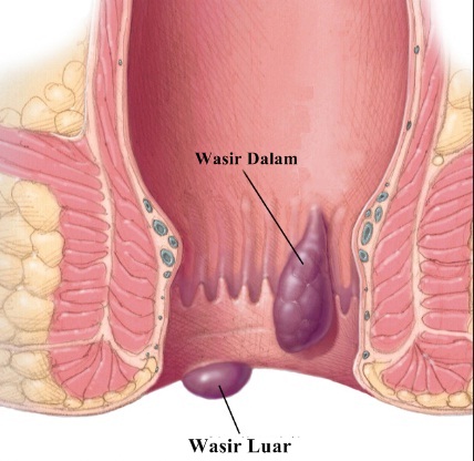 Gambar Ambeien Internal ( Dalam ) dan External ( Luar ) Gambar Ambeien Internal ( Dalam ) dan External ( Luar )