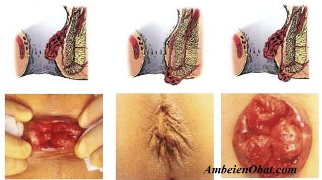 Gambar Benjolan penyakit ambeien Gambar Benjolan penyakit ambeien