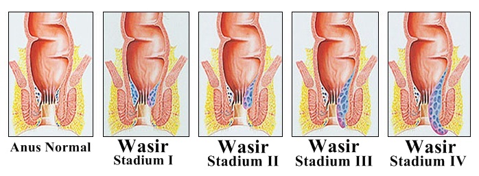 Gambar Stadium Penyakit Ambeien atau Wasir Gambar Stadium Penyakit Ambeien atau Wasir