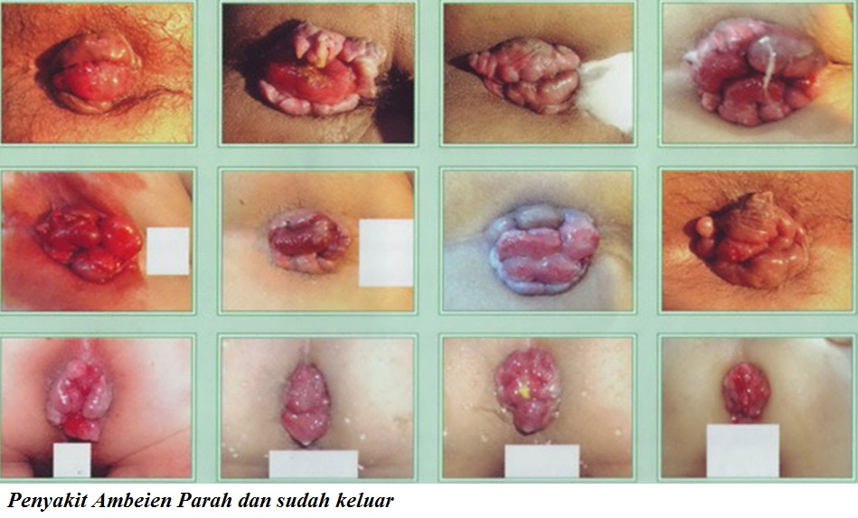 Ambeien Parah Ambeien Parah