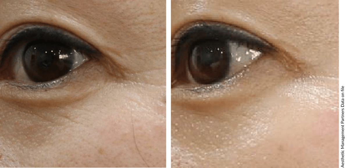 Before and after PLADUOpro treatment showing reduced fine lines and improved skin texture