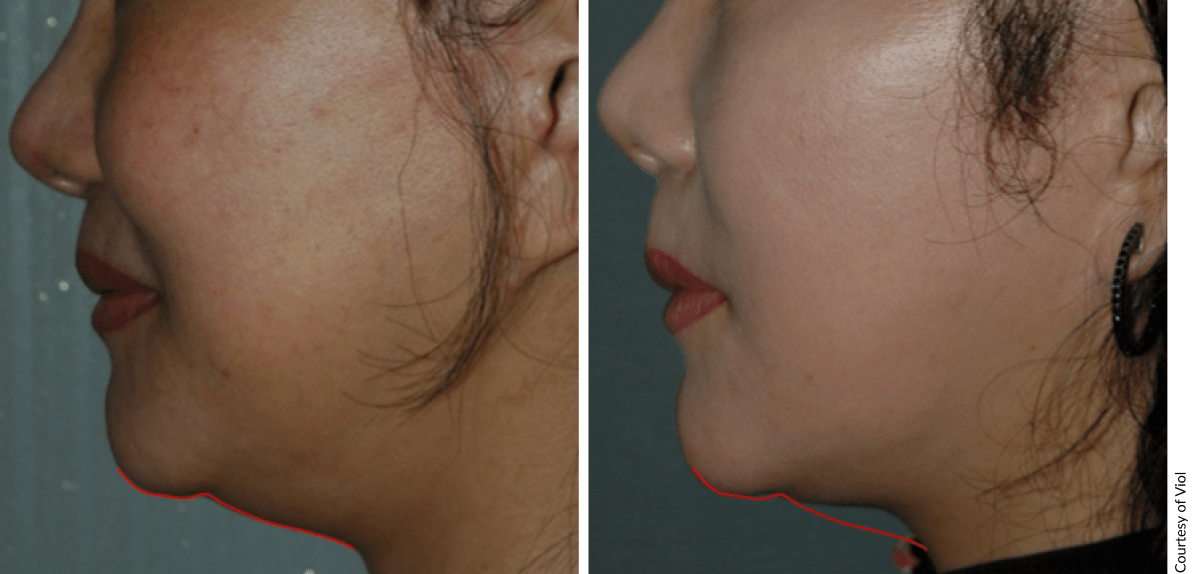 Before and after Scarlet PRO treatment showing improved facial skin texture and reduced fine lines