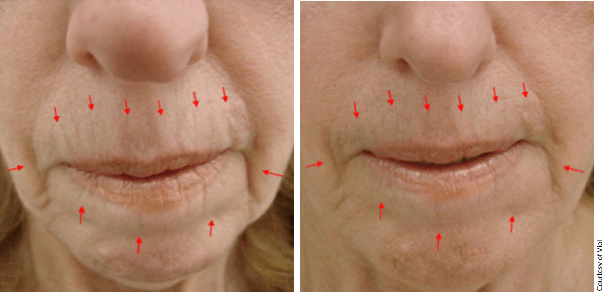 Before and after Scarlet PRO RF microneedling demonstrating skin tightening and contouring results