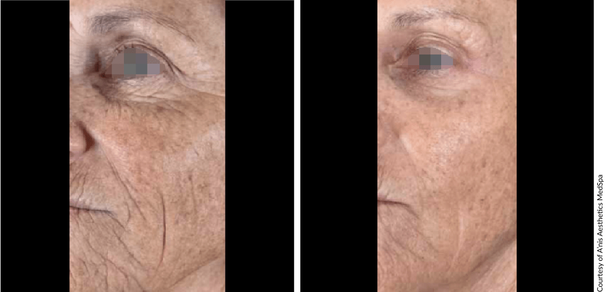 Before and after Scarlet PRO treatment displaying acne scar reduction and overall skin rejuvenation