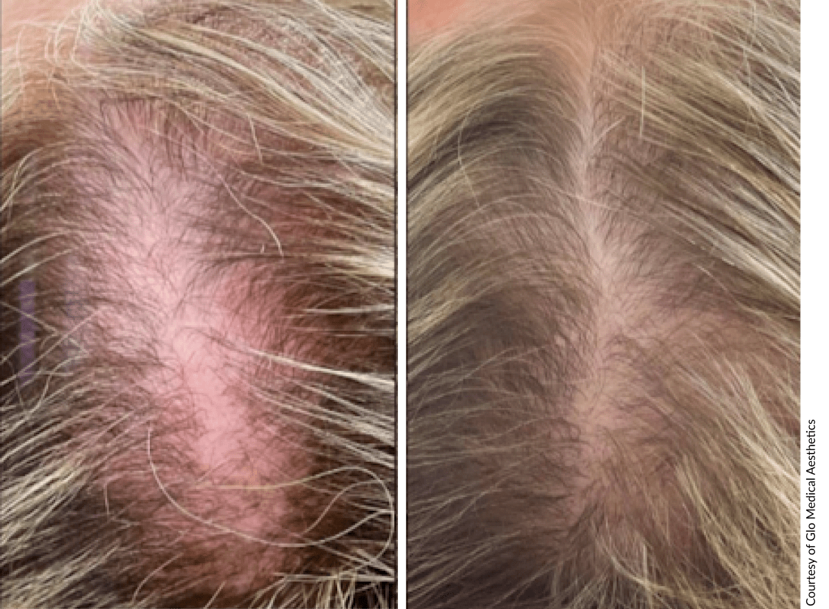 Before and after results demonstrating visible hair regrowth and fuller appearance with DE|RIVE system