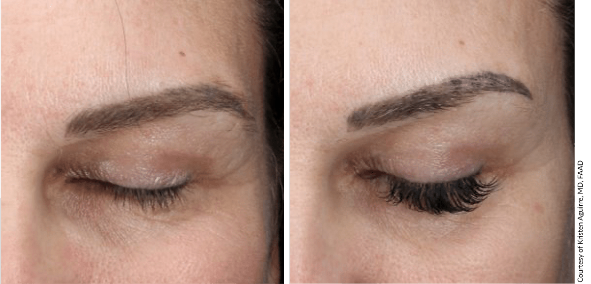 EXO|E before and after results showing skin improvement after treatment