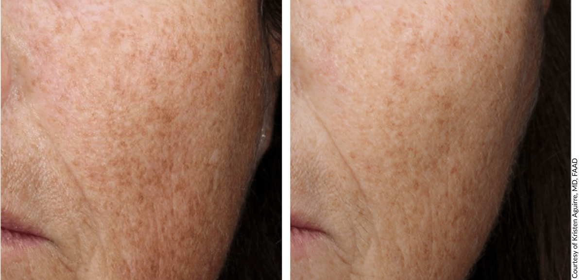 EXO|E before and after comparison demonstrating visible skin texture enhancement