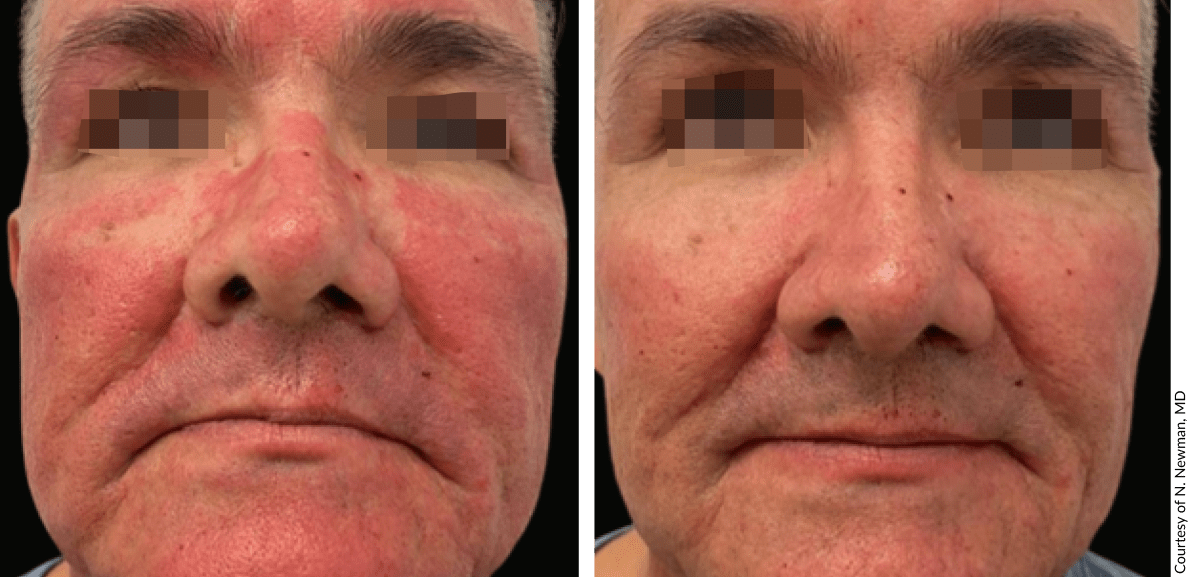 EXO|E treatment results showing improved skin tone and reduced fine lines
