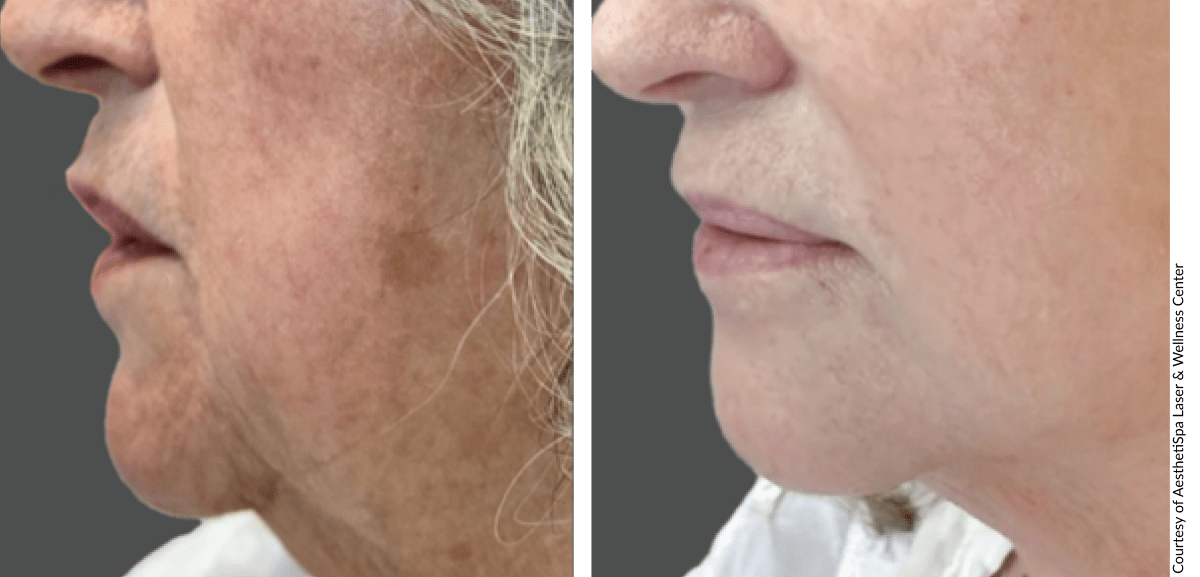 NOUVADerm results comparing skin appearance before and after fractional resurfacing treatment