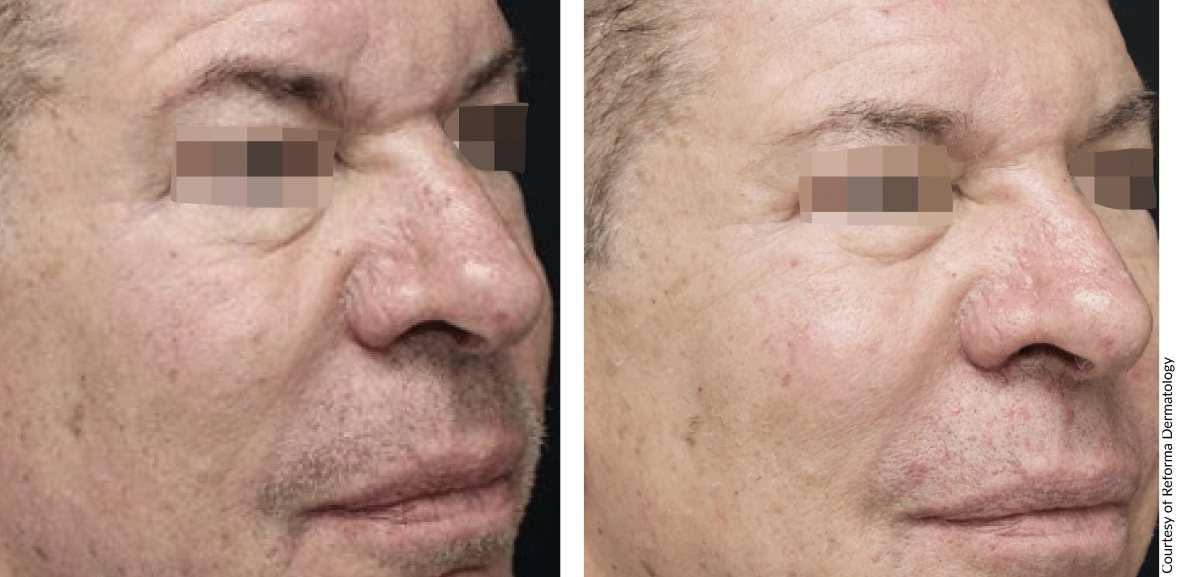 Patient skin transformation with NOUVADerm laser showing visible firmness improvement