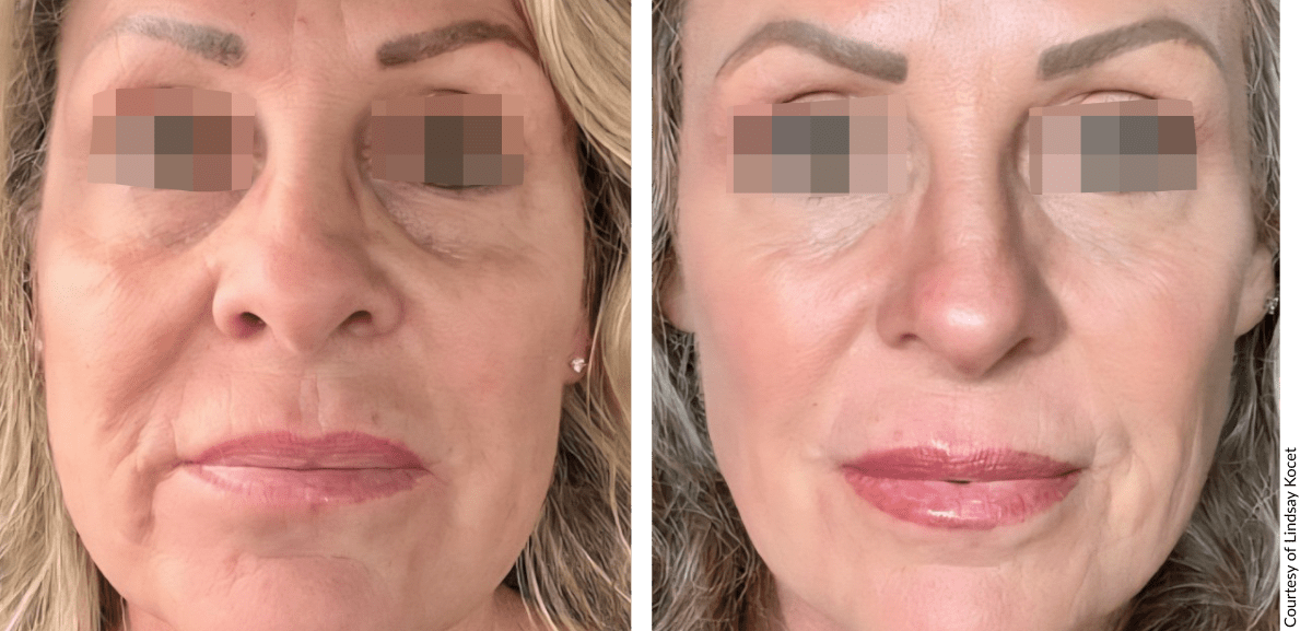 Before and after NOUVADerm treatment showing improved skin texture and tone on face