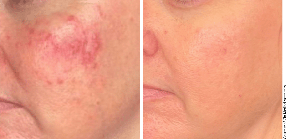 Before and after AQUAFIRMExs treatment showing improved skin tone and texture