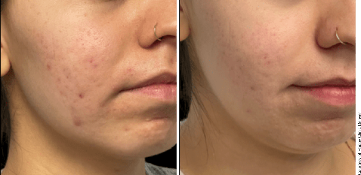 AQUAFIRMExs results comparing skin appearance before and after hydration treatment