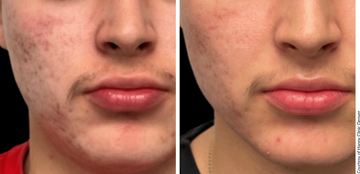 Patient skin transformation with AQUAFIRMExs showing visible radiance improvement