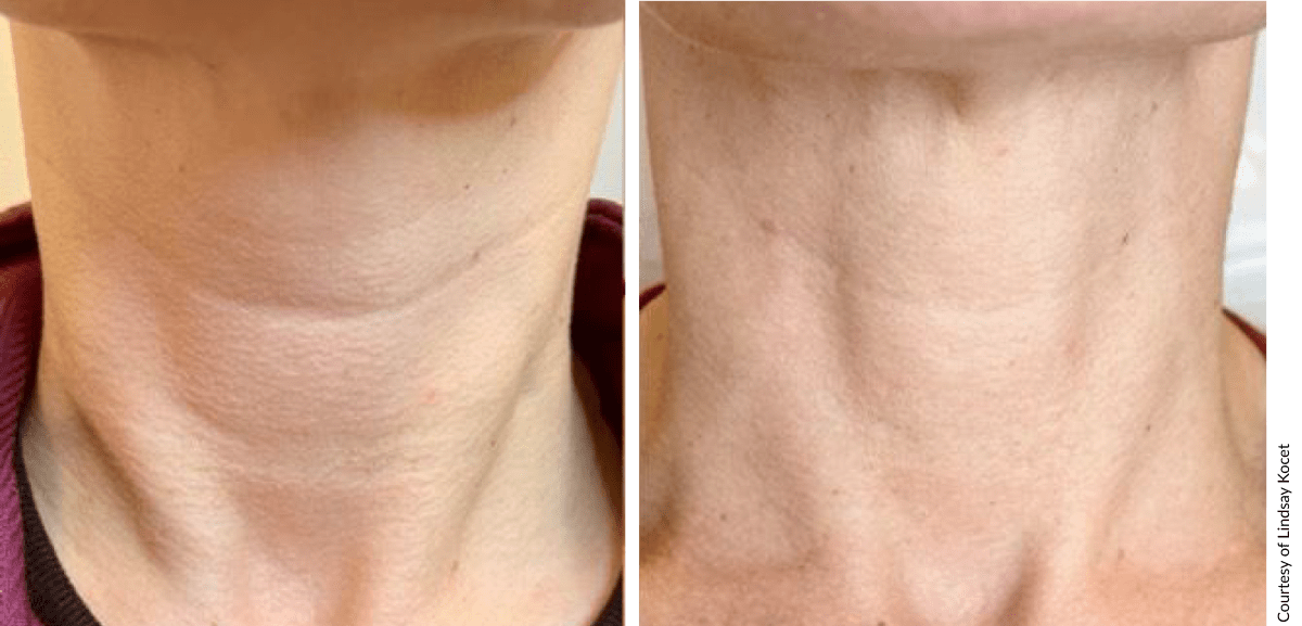 Before and after results of Cellenis Derma PRP showing skin revitalization