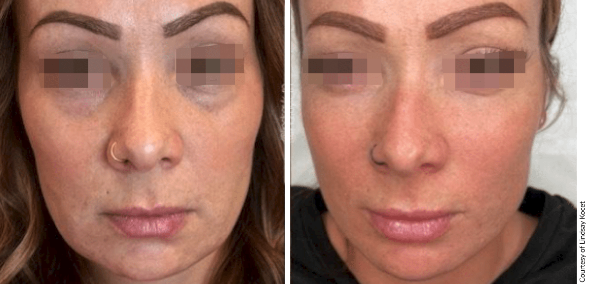 Before and after facial rejuvenation with Cellenis Derma PRP showing improved skin texture