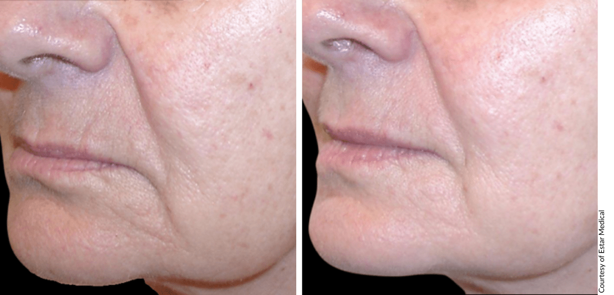 Before and after skin rejuvenation showing improved texture and tone