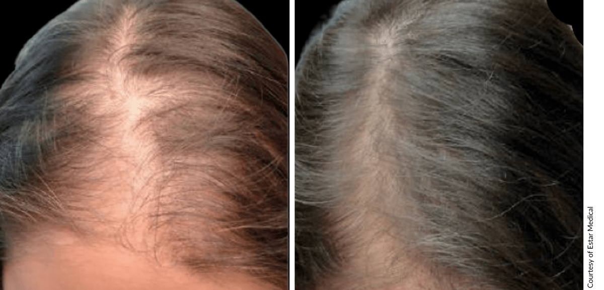 Before and after hair restoration showing increased density