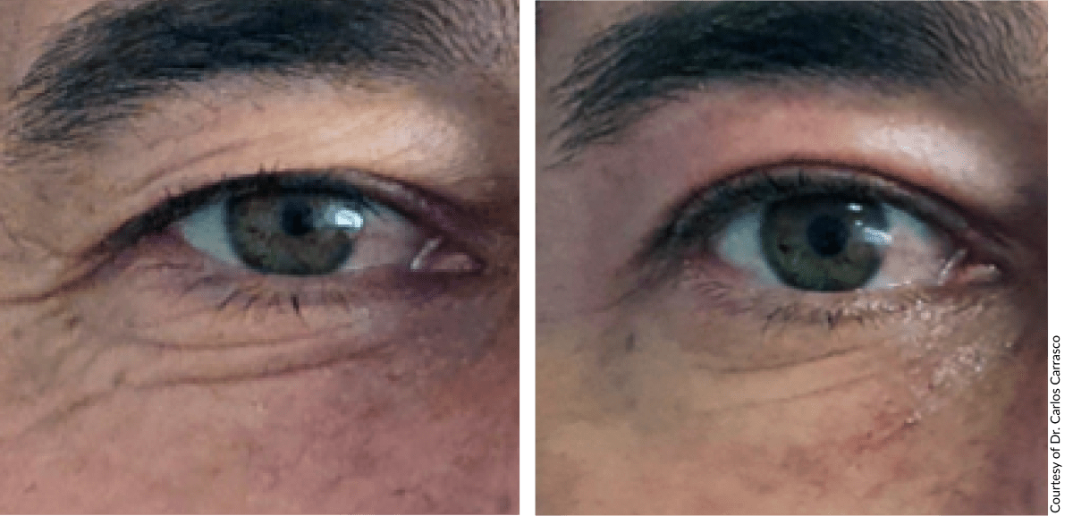 Before and after Plasmage® treatment showing crepey skin improvement