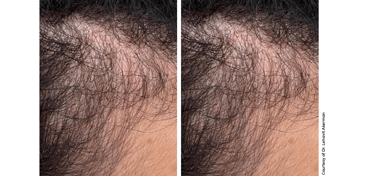 Exo-ME Hair Results