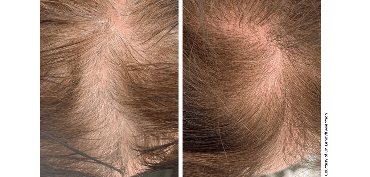 Exo-ME Hair Results
