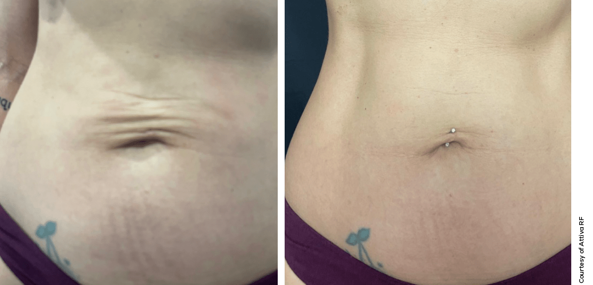 Attiva Abdomen Tightening