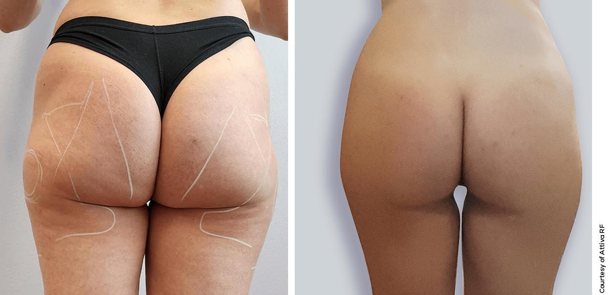Attiva Body Contouring