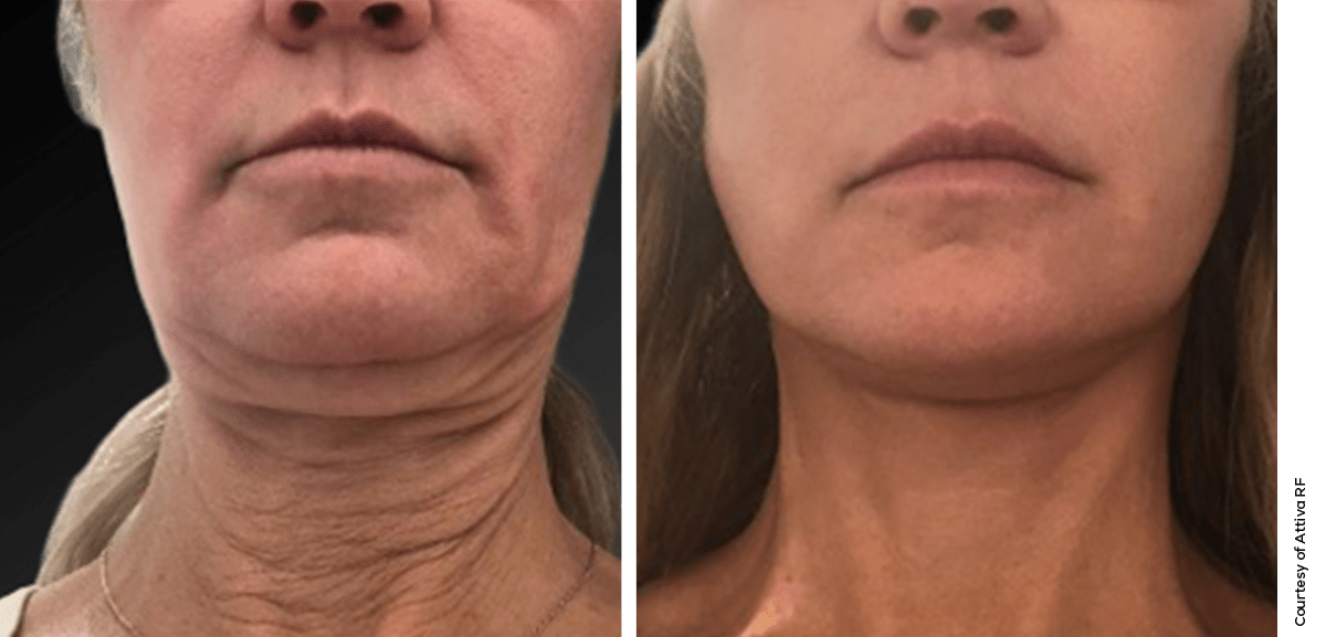 Attiva Neck Contouring Results