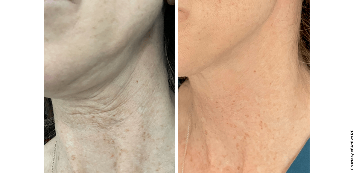 Attiva Neck Contouring Results